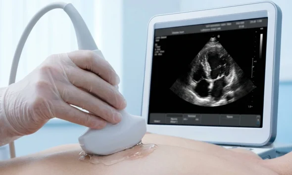 Mayo AI model detects HCM LVOT obstruction standard ultrasound