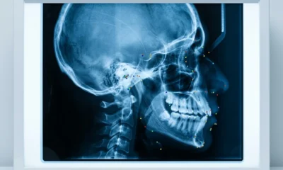 Res-SwinFusion hybrid AI anatomical landmark localization X-ray