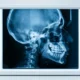 Res-SwinFusion hybrid AI anatomical landmark localization X-ray